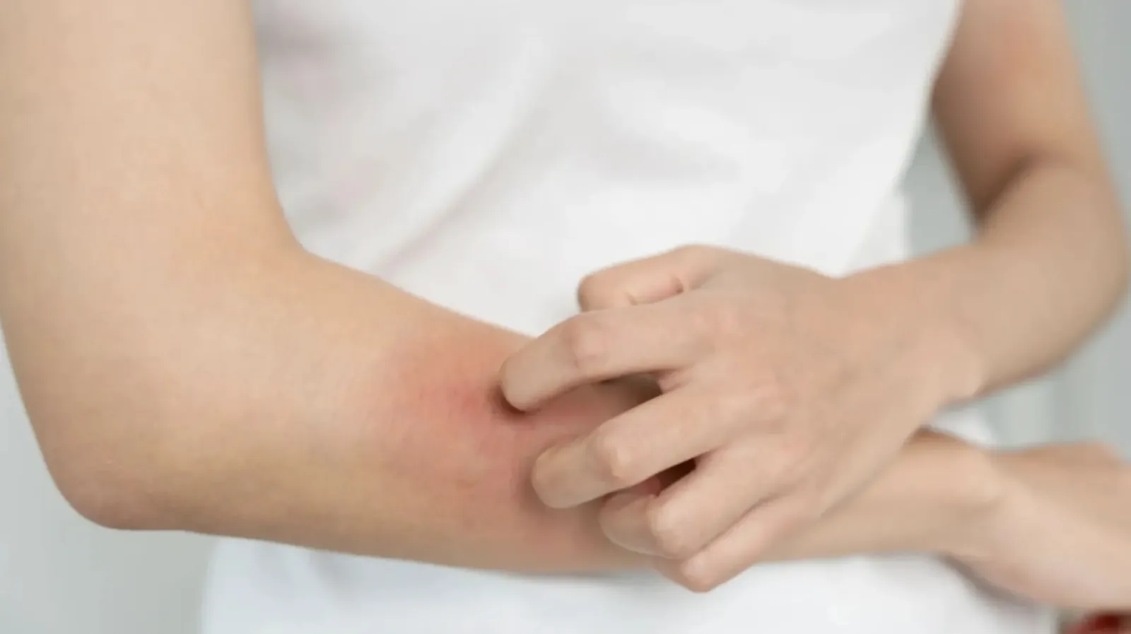 北市麻疹個案+1。（示意圖，freepik提供）