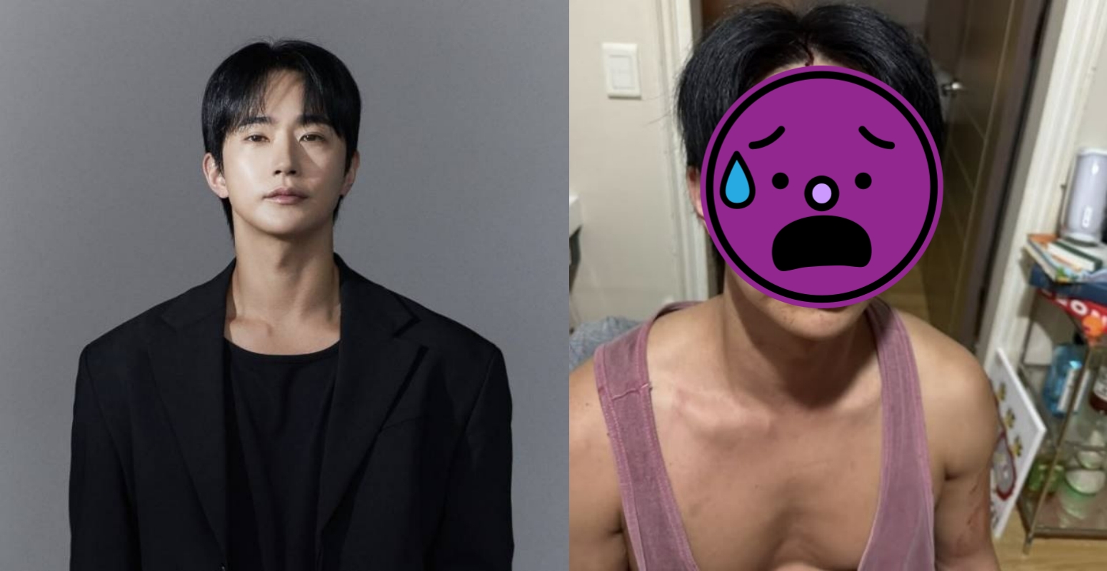 韓國音樂劇演員全浩俊被控家暴，他貼出受傷照表示自己動手是正當防衛。（翻攝全浩俊 INS）