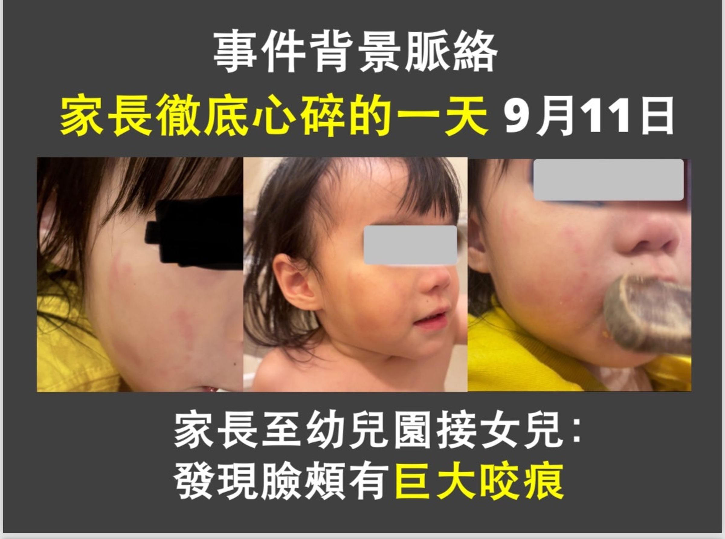 2歲女童小茹(化名)今年8月到幼兒園上學後，身上陸續出現大小不一瘀青，最離譜的是，女童臉頰後來竟出現成人咬痕。（家長提供）