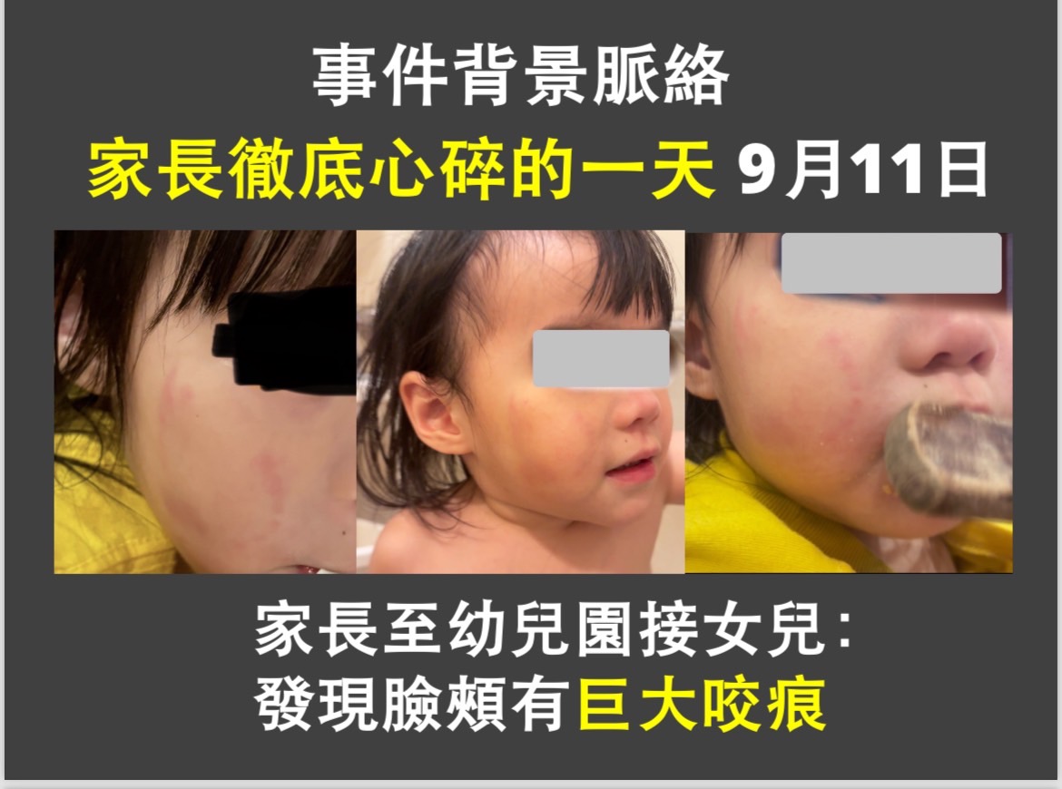 2歲女童小茹(化名)今年8月到幼兒園上學後，身上陸續出現大小不一瘀青，最離譜的是，女童臉頰後來竟出現成人咬痕。（家長提供）