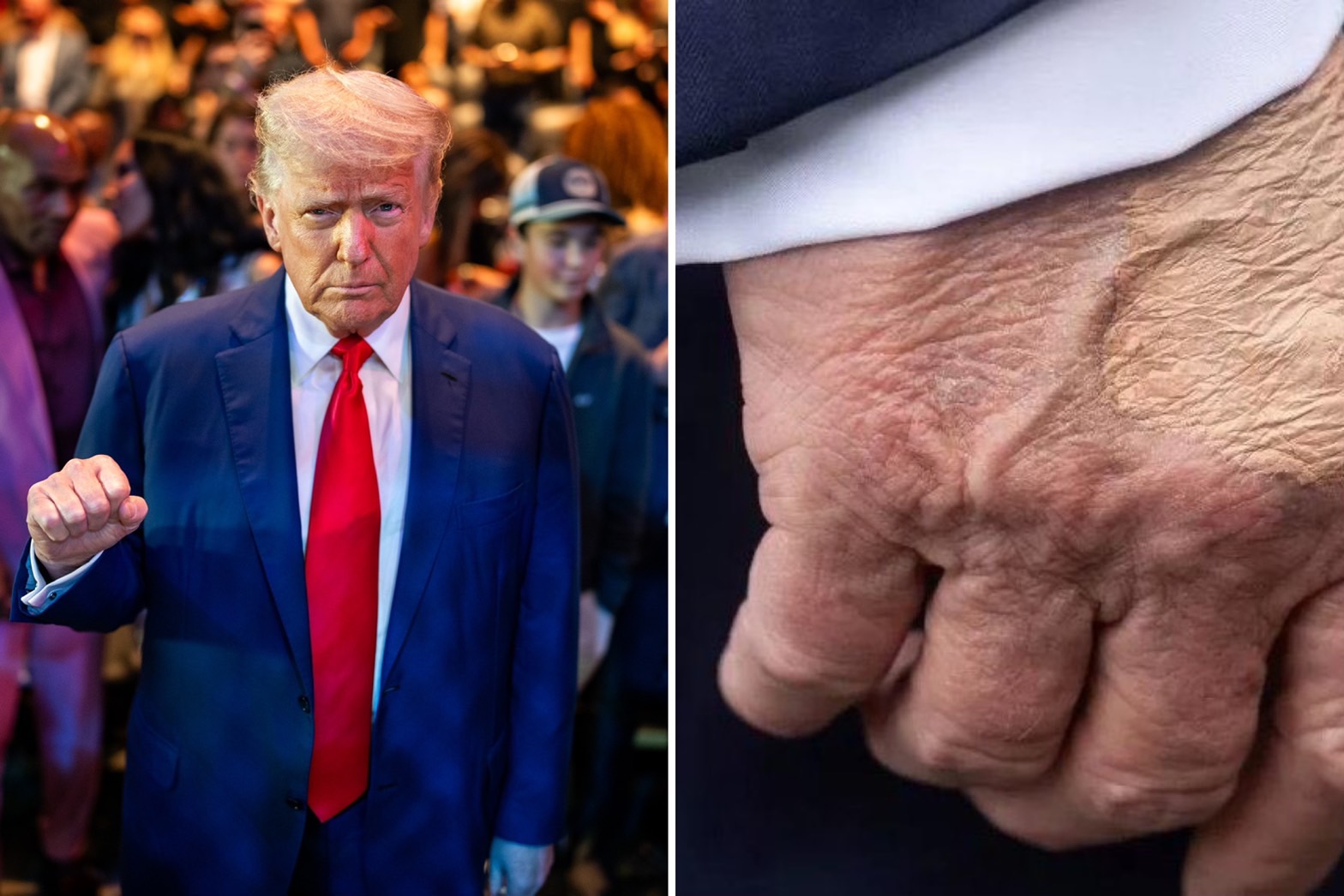 美國總統川普手部瘀青（右）被質疑健康狀況亮紅燈。（翻攝X）