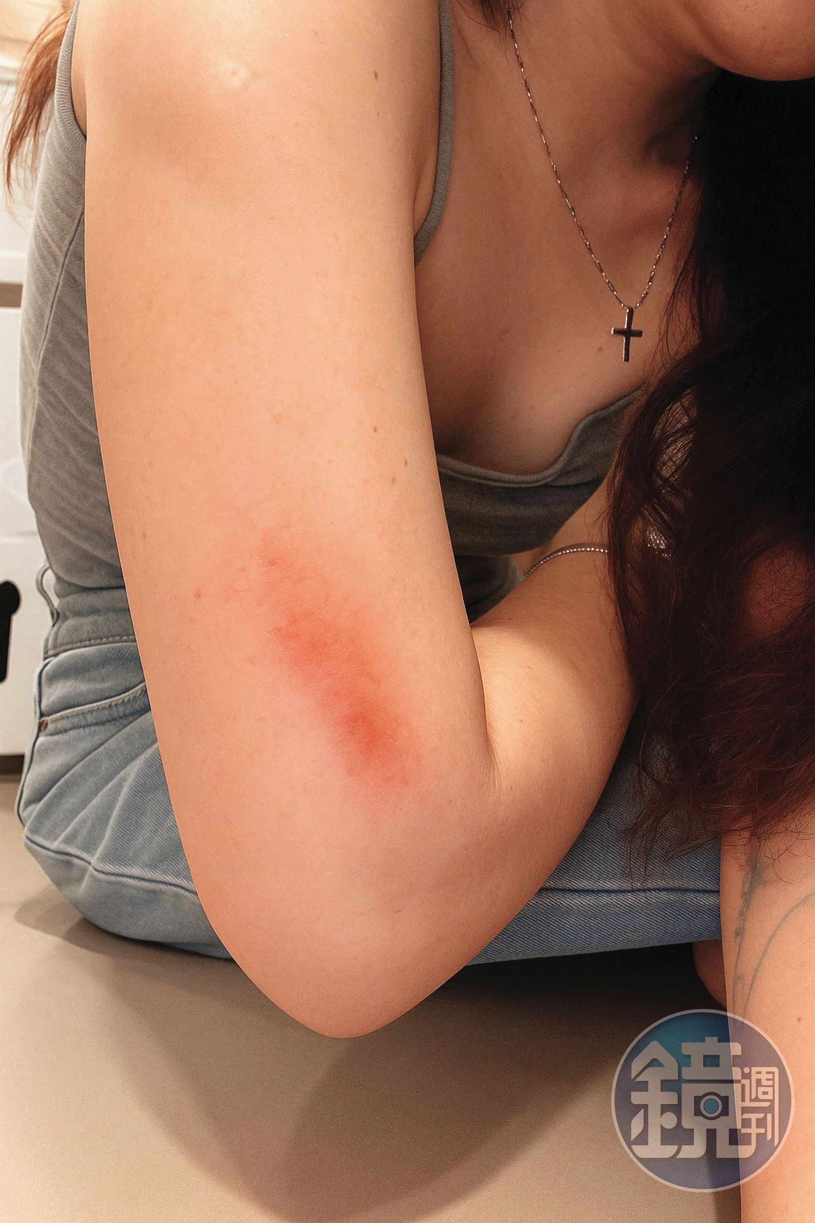 多次被打的A小姐已向警方報案，控告楊居霖詐欺、家暴。（讀者提供）