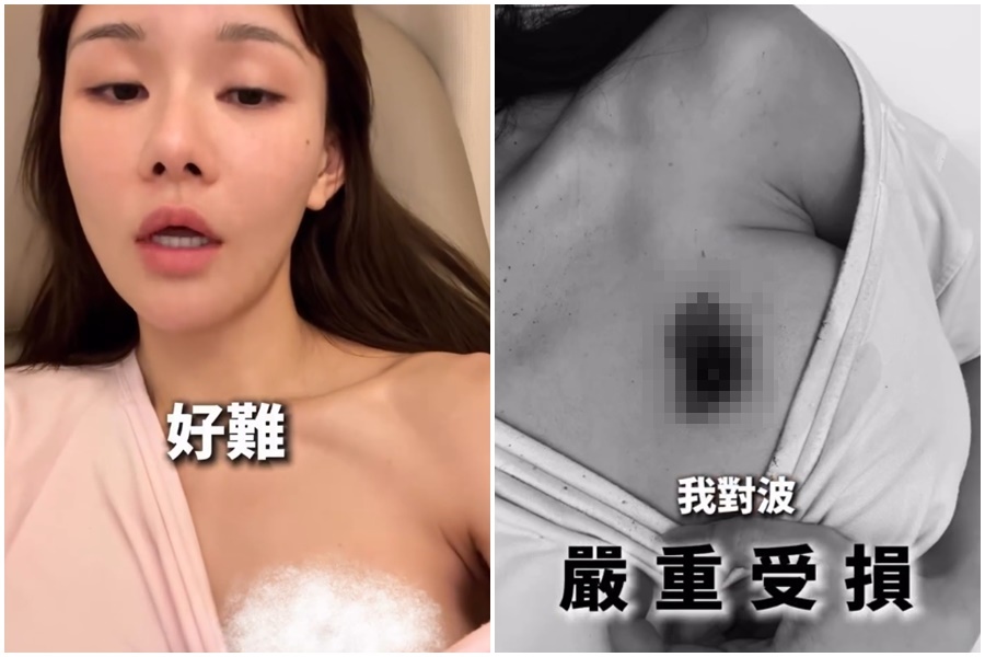 香港「最強小三」鍾睿心拍片展示胸部被燙傷留下的疤痕。（翻攝自IG@5kidsokma_no1fans）