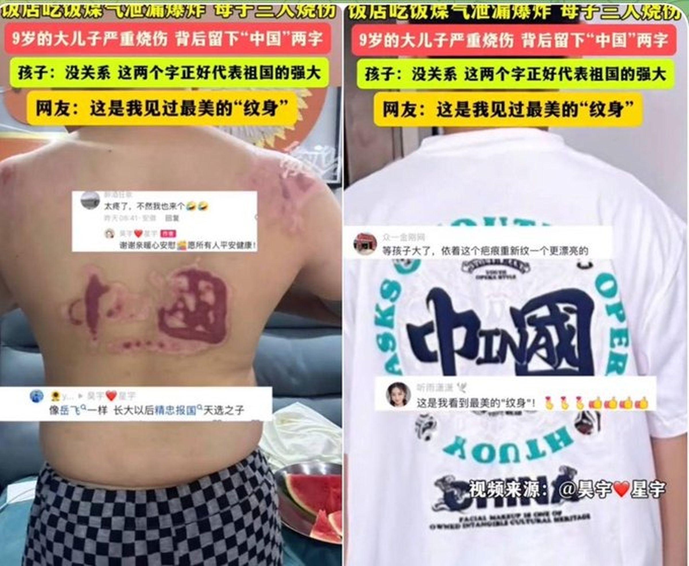 男童吃飯遇氣爆被燒傷，背部烙印「中國」！小粉紅變態喊：精忠報國。（翻自微博）