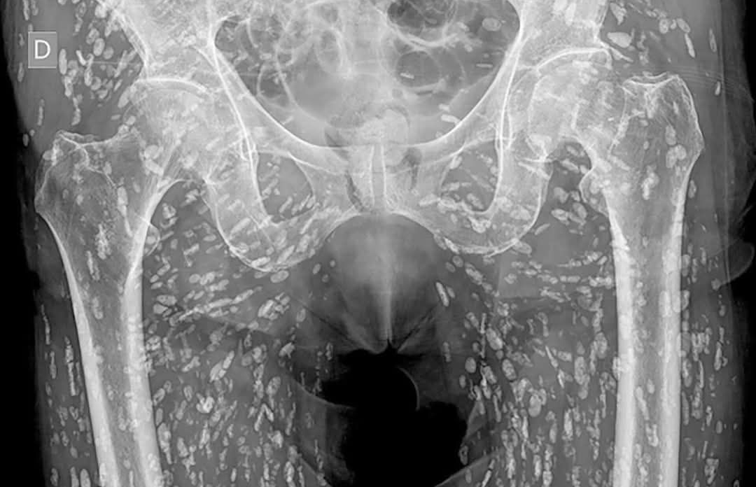 一名婦人照X片發現體內布滿大量寄生蟲。（翻攝臉書粉專ไอ้แจ๋ว เมืองจันท์）