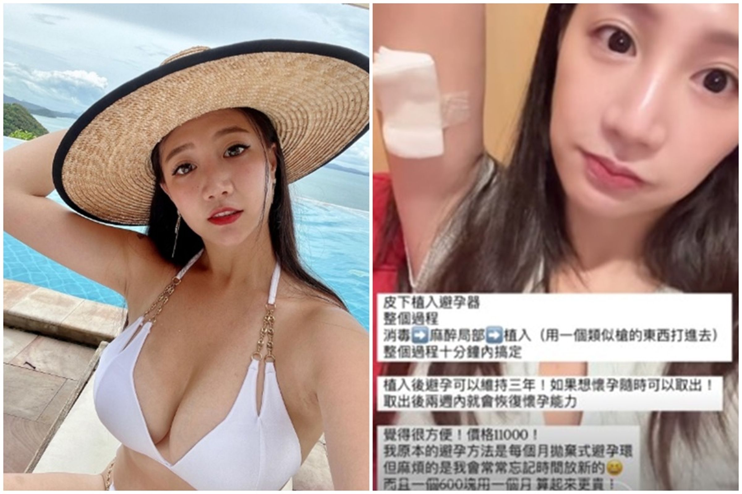 林采緹近日坦言「不愛男友戴套」,跑去植入避孕器。(翻攝自林采緹IG)
