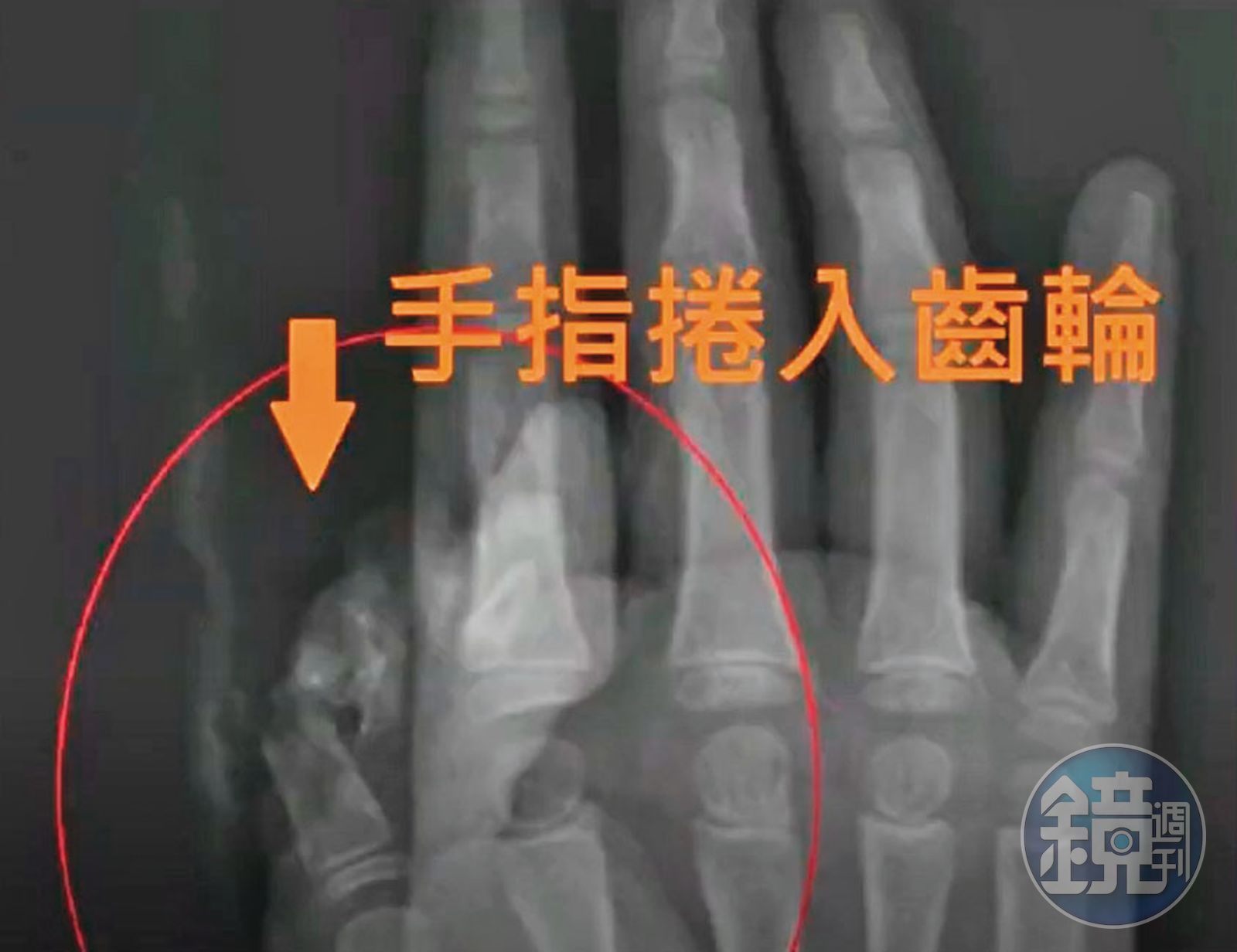 吳小姐的女兒大拇指捲入升降椅齒輪，導致傷殘。（讀者提供）