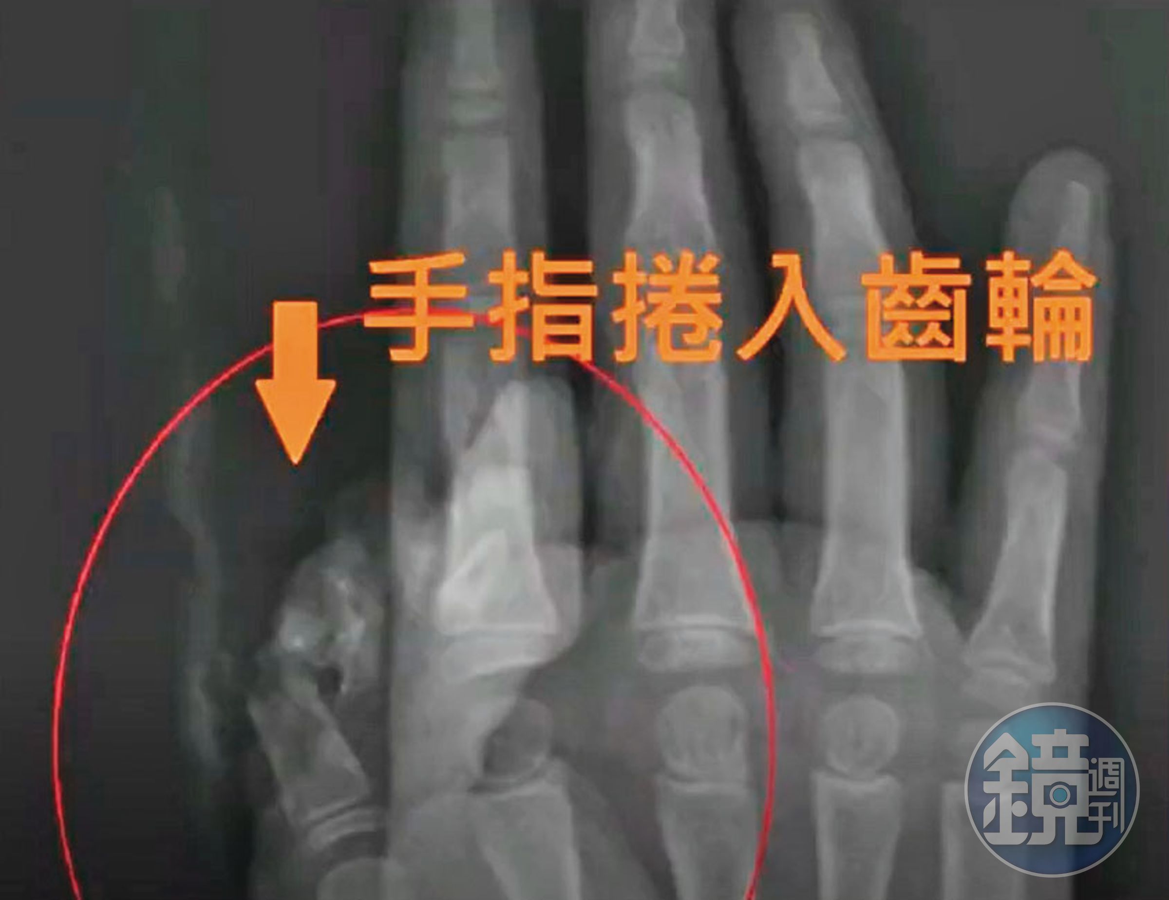 吳小姐的女兒大拇指捲入升降椅齒輪,導致傷殘。(讀者提供)