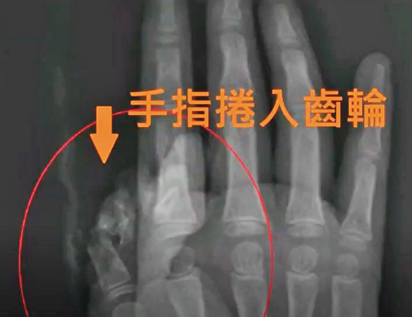吳小姐的女兒大拇指捲入升降椅齒輪，導致傷殘。（讀者提供）