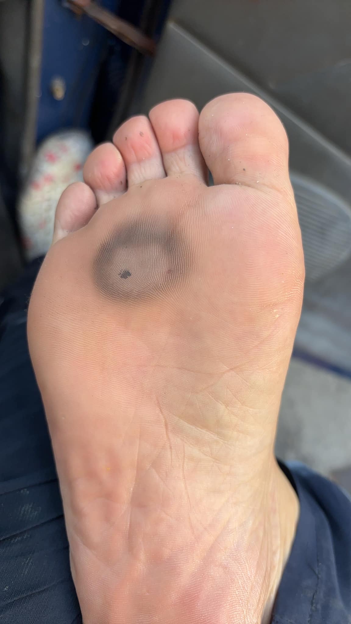 原PO脫鞋一看，發現腳底直接被燙到黑一圈。（翻攝自臉書 爆廢1公社）