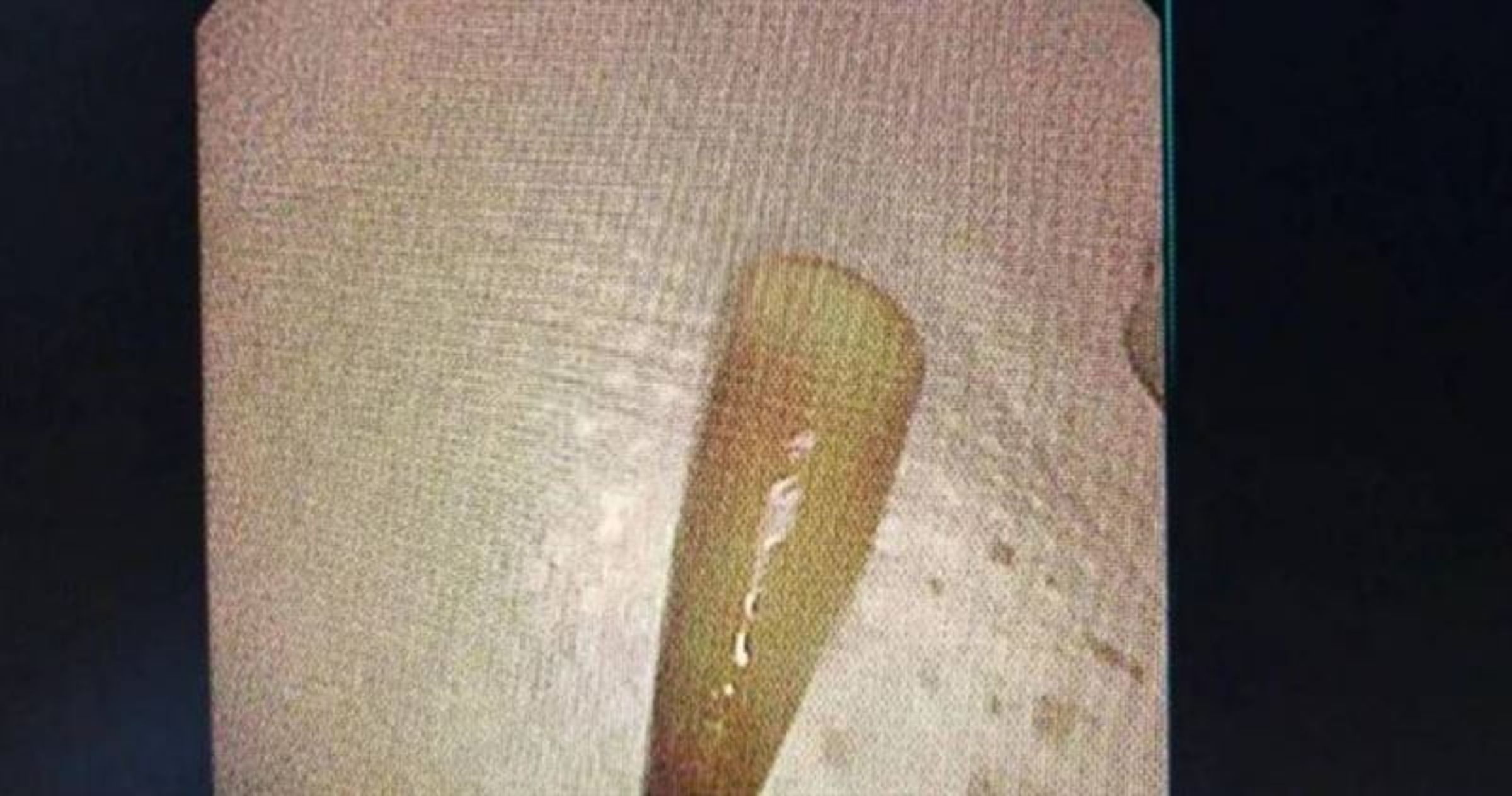 中國浙江寧波一名24歲男子,劇烈嘔吐後突然出現咳血情況,進行支氣管鏡檢查後,竟發現一枚白色塑膠筆帽。(翻攝自寧波晚報)