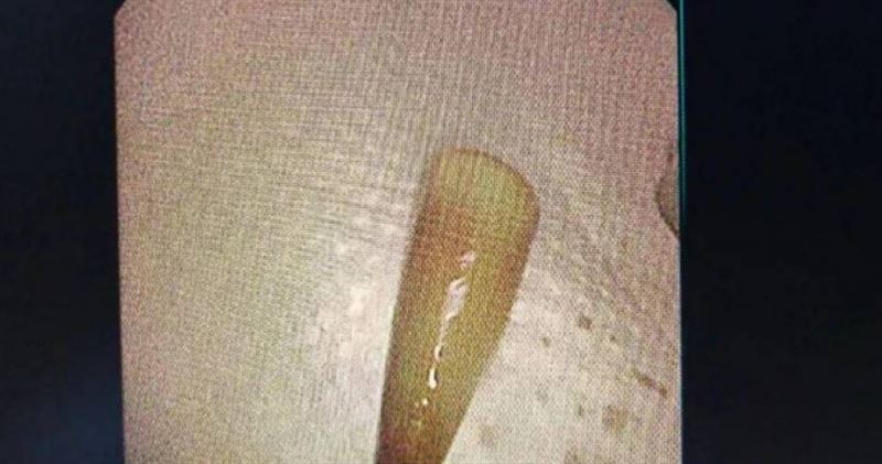 中國浙江寧波一名24歲男子，劇烈嘔吐後突然出現咳血情況，進行支氣管鏡檢查後，竟發現一枚白色塑膠筆帽。（翻攝自寧波晚報）