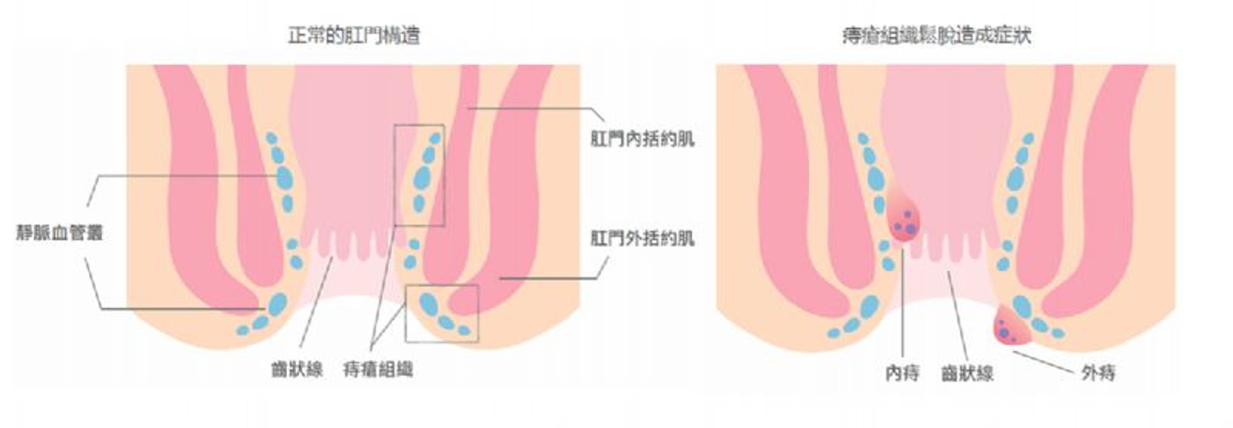 面對痔瘡問題,醫師提醒民眾無需過度羞恥或恐慌。(翻攝自衛福部網頁)