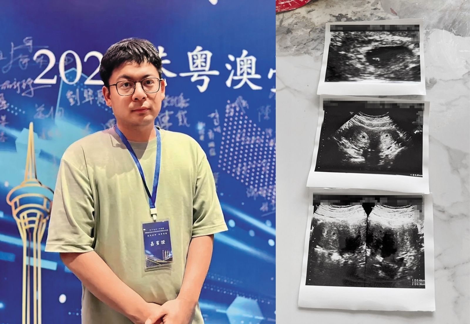 A女因聽到男友喬天鼎(左圖)的偷吃傳聞,影響情緒而流產。右圖為她當時懷孕的超音波。(翻攝自《羊城晚報》/讀者提供)