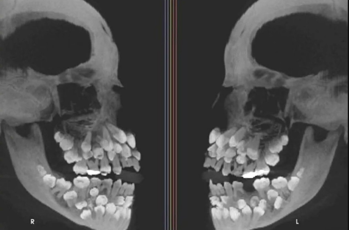巴西一位11歲女童口中驚見有81顆牙齒，情況十分罕見。（翻攝X@Rainmaker1973）