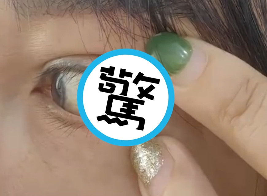 醫師執照雞腿換的？陸女割雙眼皮醫師竟「眼球眼角縫一起」　眼球不能動超慘 