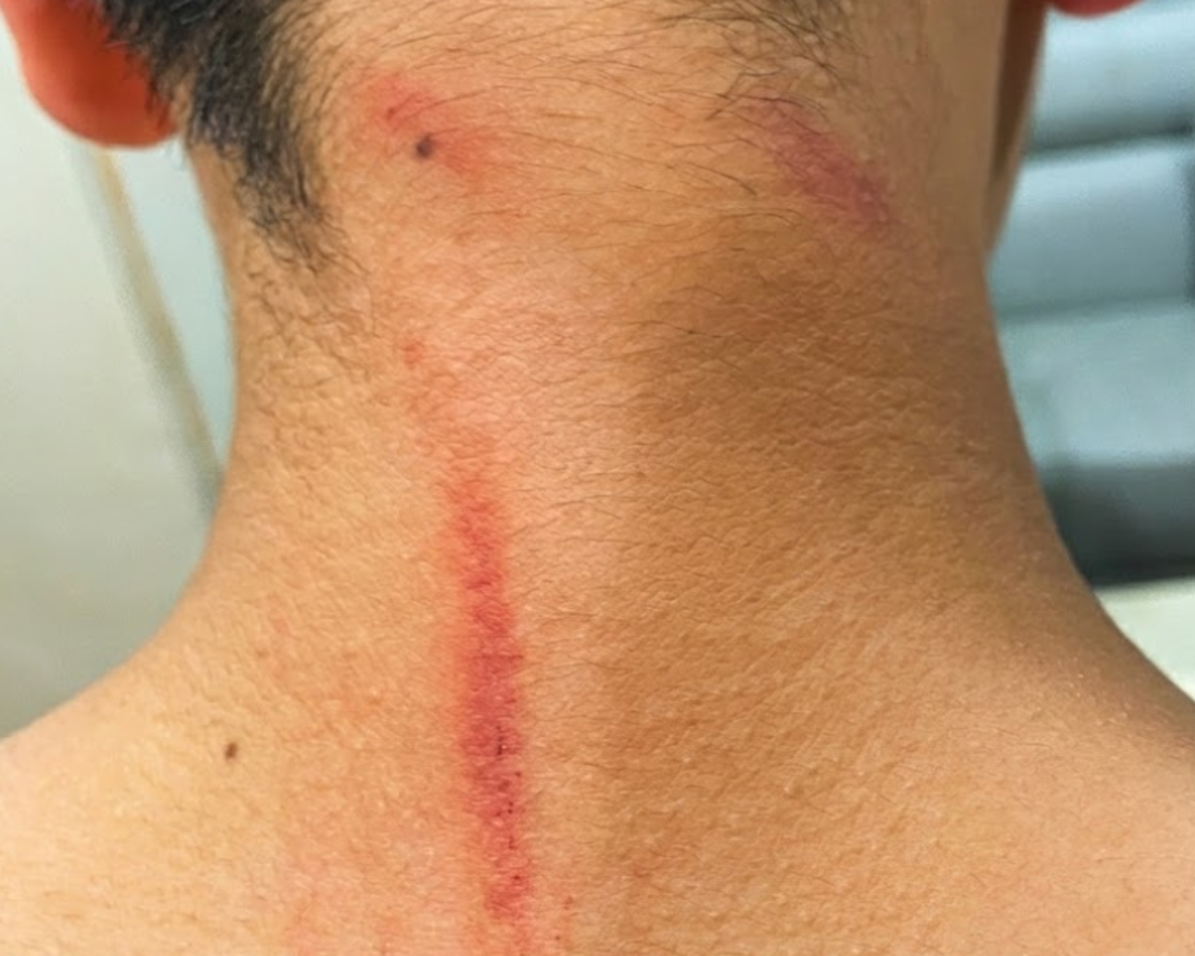 Ｂ生對小凱施暴，導致小凱的背、頸部受傷。（讀者提供）