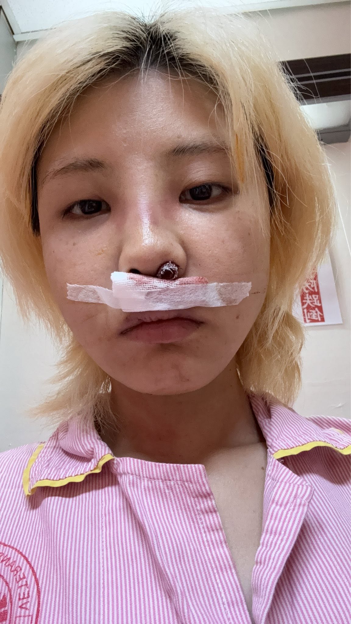 苡琍Hana控訴閨密沈琪琪介紹的醫美診所,竟在她的鼻頭埋了不合法的線材。(翻攝自臉書苡琍 - Hana )
