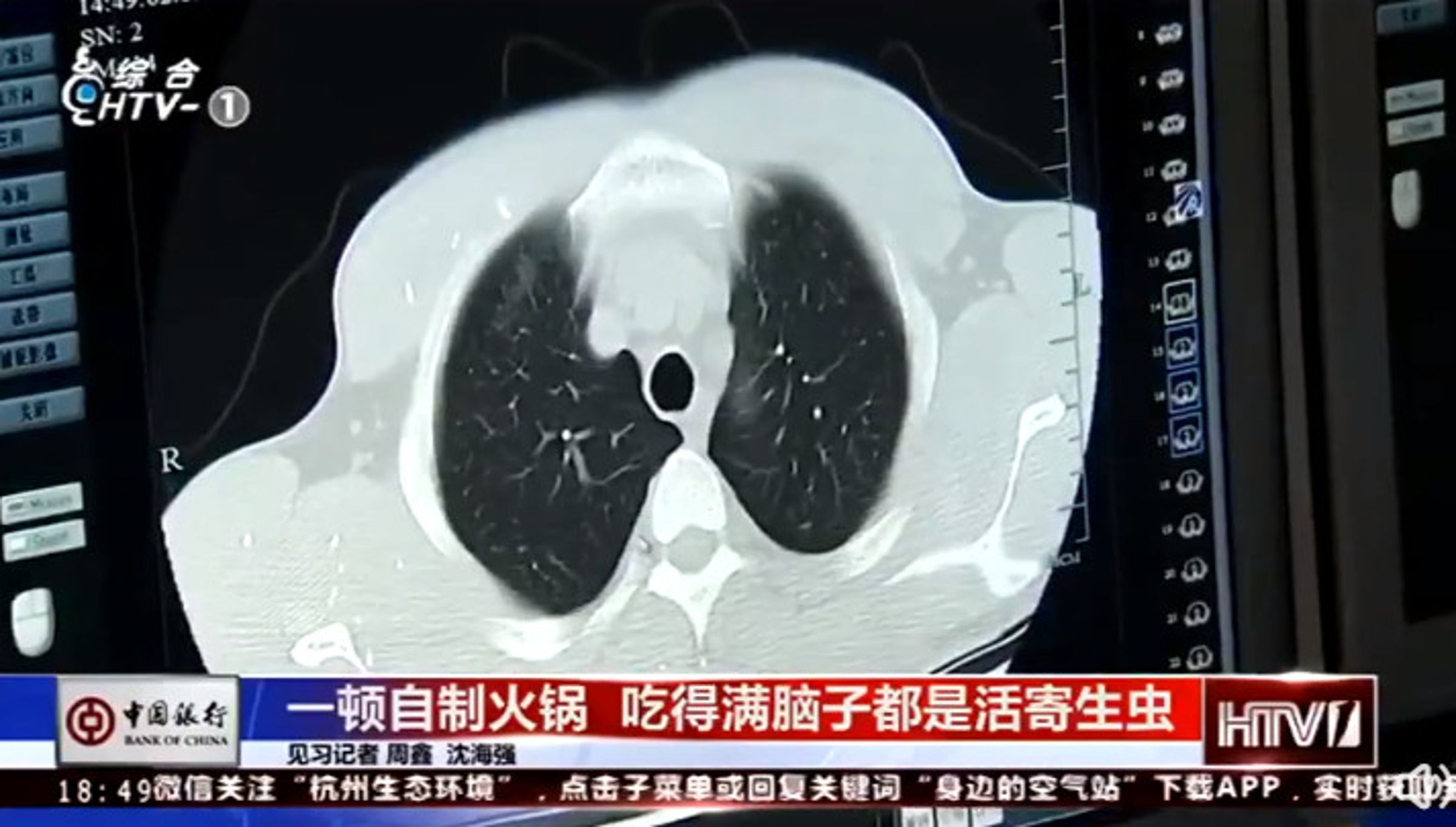 男子就醫經檢查,竟在腦中發現許多絛蟲。(翻攝微博)
