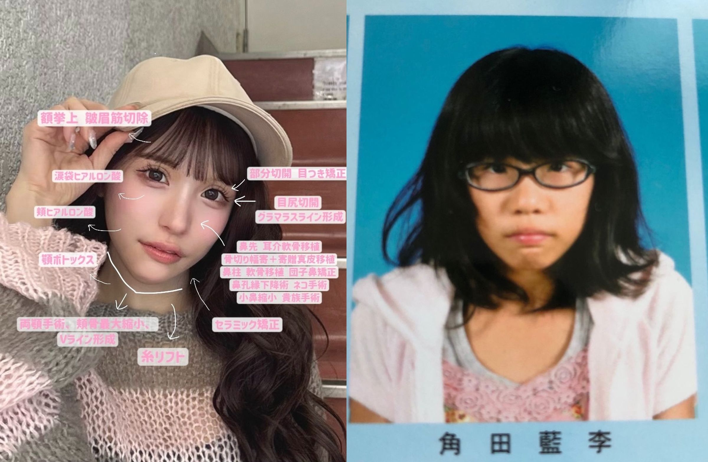 平瀨愛理詳細揭露整形部位與總花費。(翻攝自平瀨愛理X)
