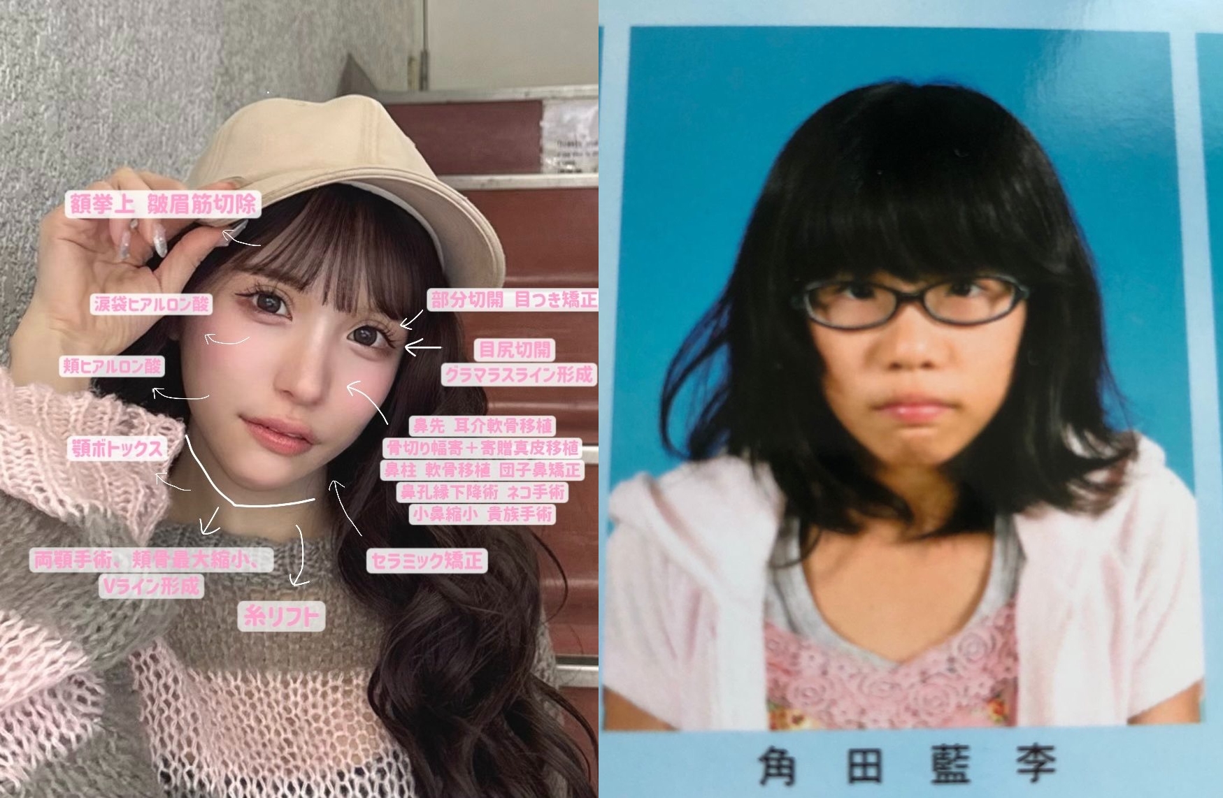 平瀨愛理詳細揭露整形部位與總花費。（翻攝自平瀨愛理Ｘ）