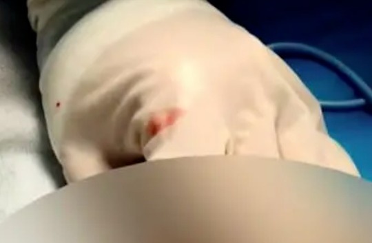 一名13歲錢姓少年日前到當地做「包皮」小手術，卻沒想到半個月後，左側睪丸竟壞死最終僅能切除。（翻攝自微博）