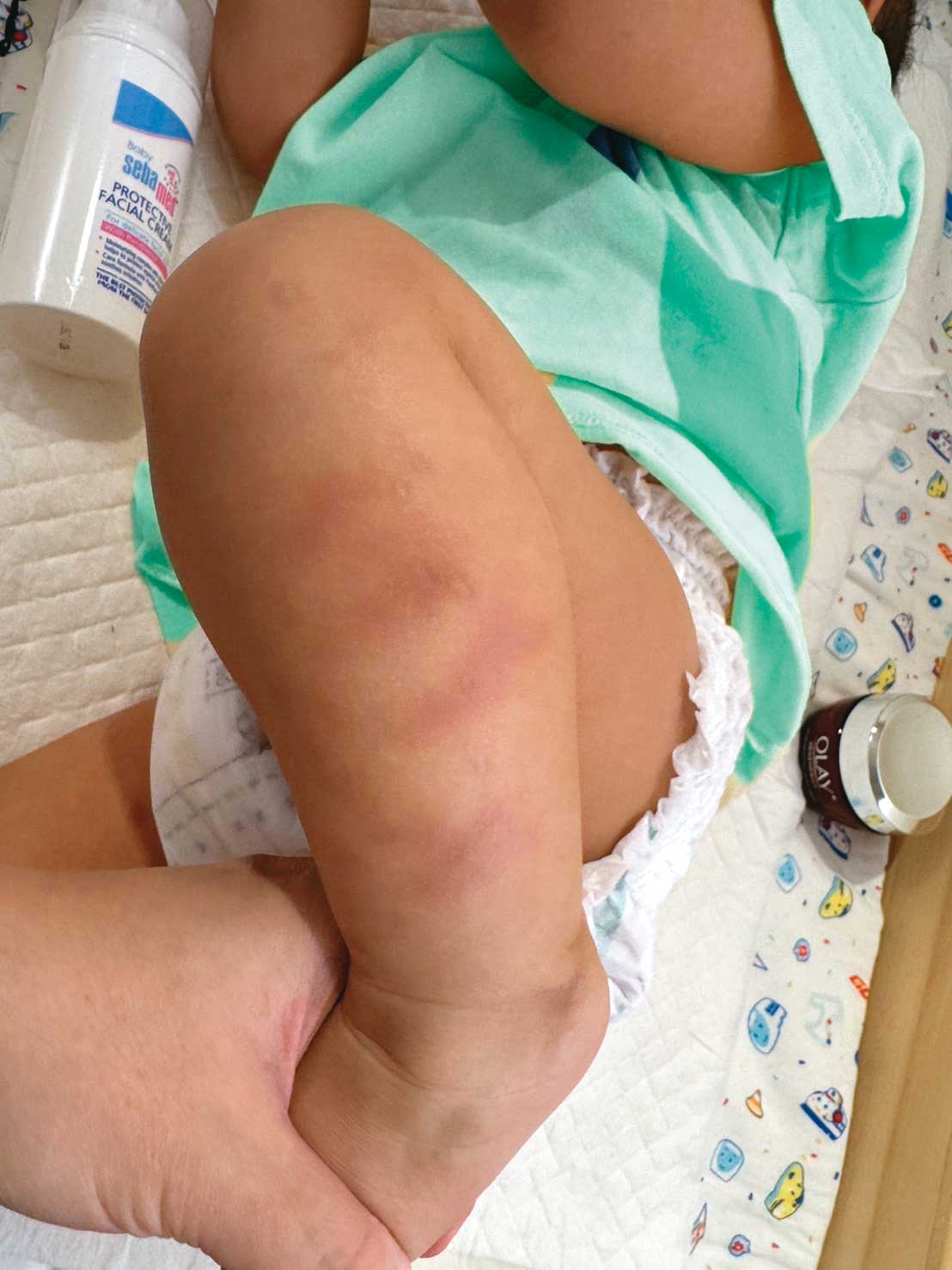 A妻上月發現小孩腿上有手指狀瘀青,驗傷報案並調閱監視器後才知兒子遭虐。(讀者提供)