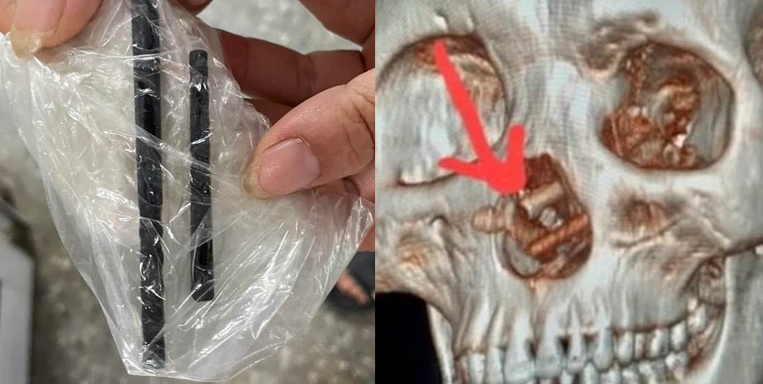 越南男子接受電腦斷層檢查，發現顱骨內插進一雙筷子。（翻攝X@MailOnline、@PhamDuyHien9）