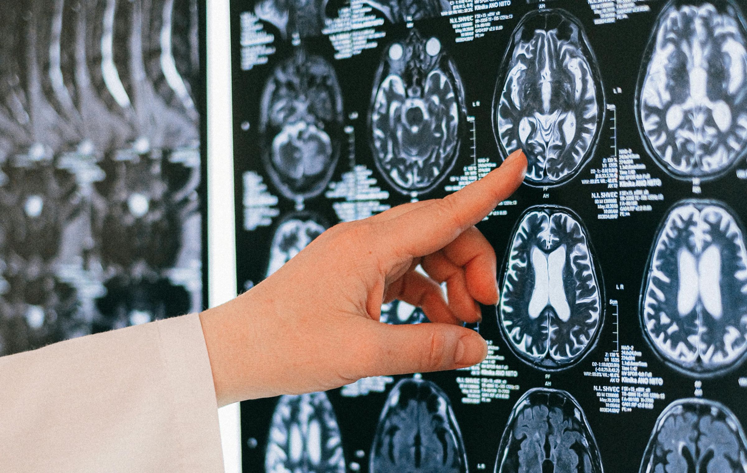 哈佛醫學院研究團隊發表最新研究,指出大腦鋰含量可能與阿茲海默症的發展相關。(翻攝自pexels)