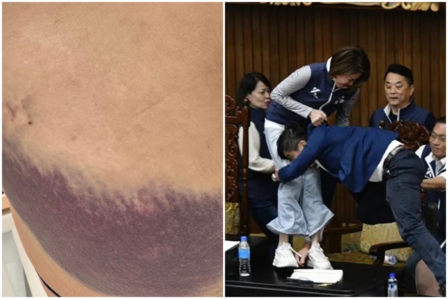 綠委鍾佳濱藉機躍上主席台，將藍委陳菁徽以格鬥姿勢2度「擒抱撲倒」，導致對方臀部一片瘀青。（翻攝自陳菁徽臉書、本刊資料照）