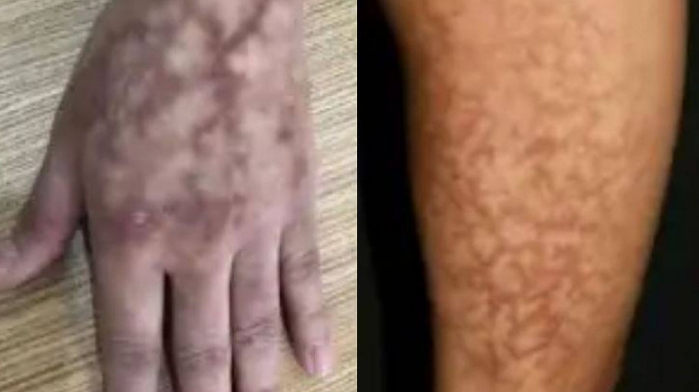 中國一名婦人因長期貼身用熱水袋取暖,導致出現大片網狀紅斑。(翻攝微博)