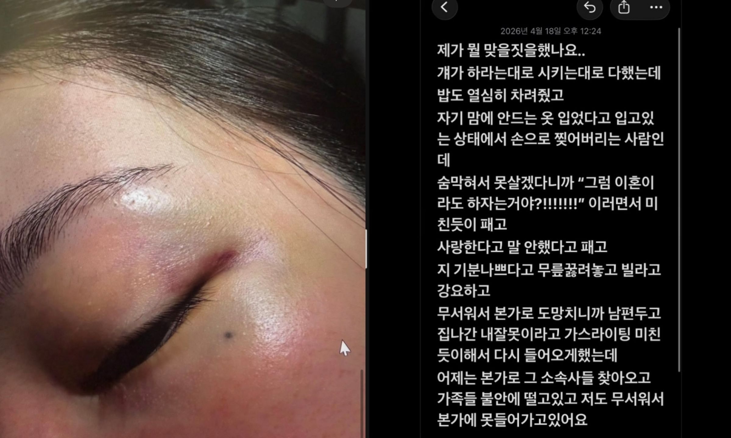 南韓網路論壇出現「女團成員親哥哥妻子爆料家暴事件」貼文,曬出多張觸目驚心照片。(翻攝the qoo)