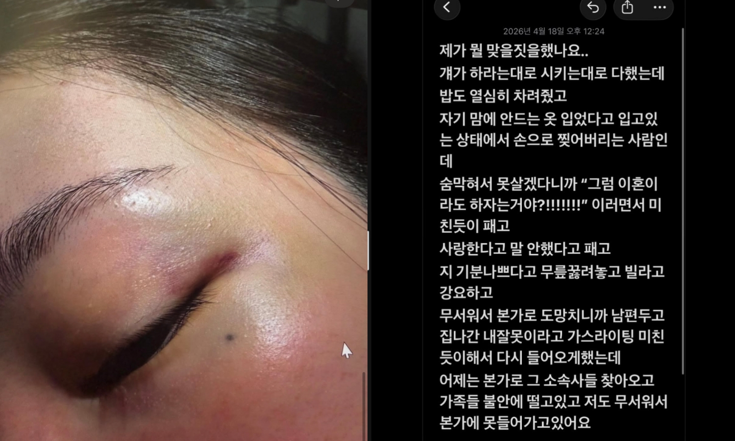 南韓網路論壇出現「女團成員親哥哥妻子爆料家暴事件」貼文，曬出多張觸目驚心照片。（翻攝the qoo）