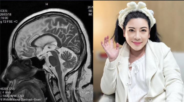 陳文茜曬出最新腦部MRI影像未發現癌細胞。（翻攝自「文茜的世界周報 Sisy's World News」臉書）