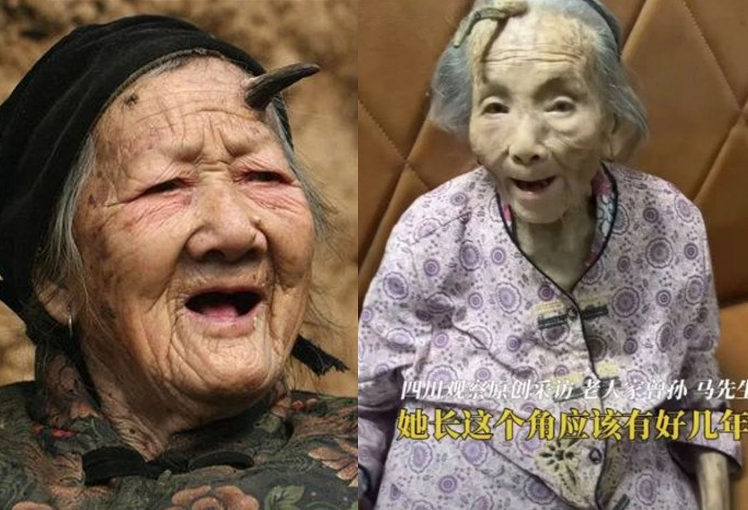 中國百歲人瑞驚傳頭上長角,醫生認為需進一步檢查確認是良性或惡性皮膚病變。(翻攝微博)