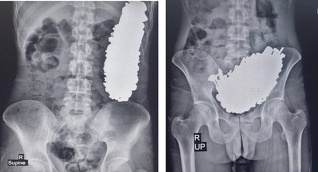 「鋼鐵人」是你？男狂吞452件螺絲鑰匙，胃部塞滿3公斤金屬製品 。（翻自《每日郵報》）