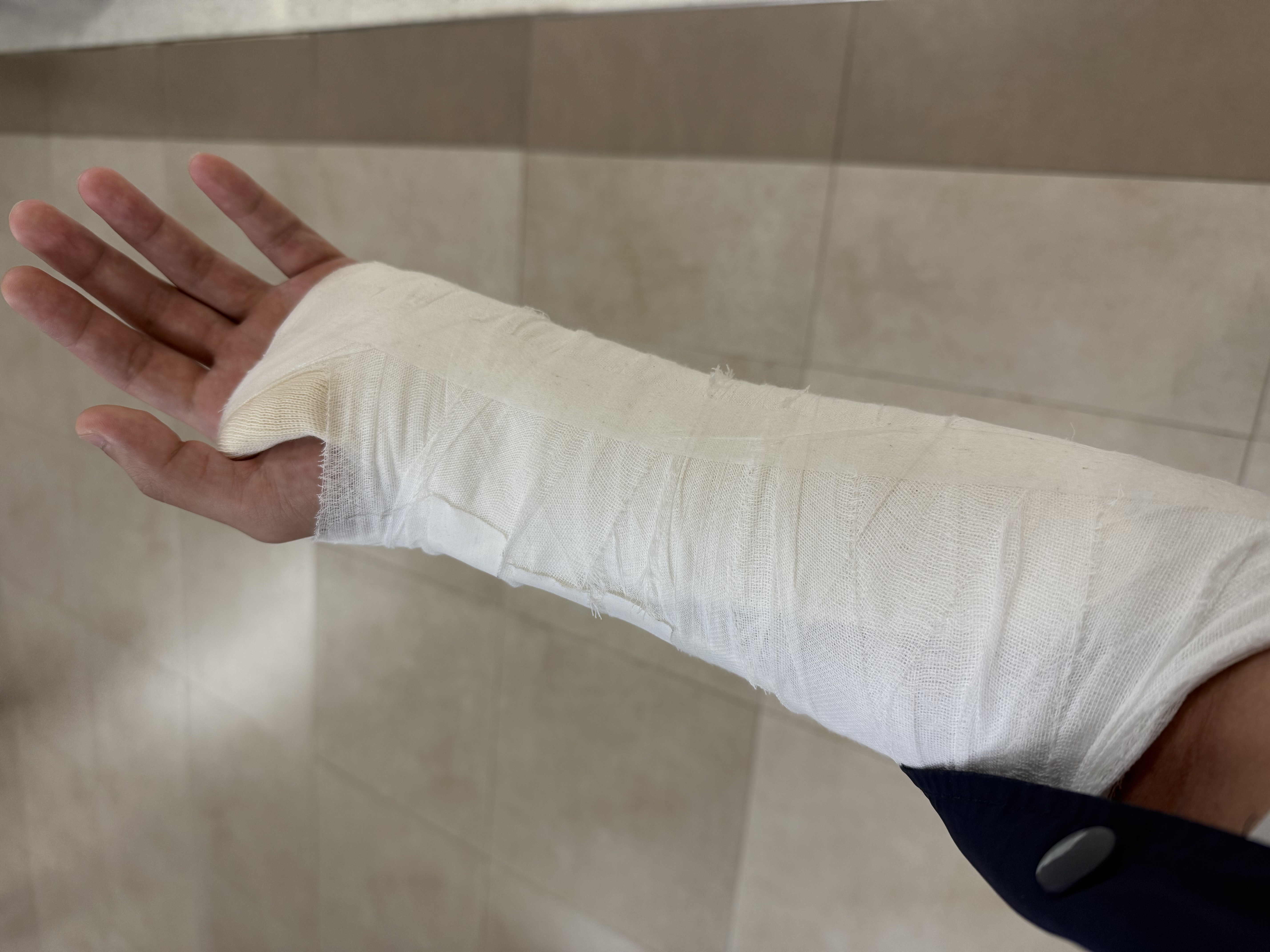 陳姓護理師的左手腕韌帶經開刀後仍需休養,目前處於公傷假期間。(讀者提供)