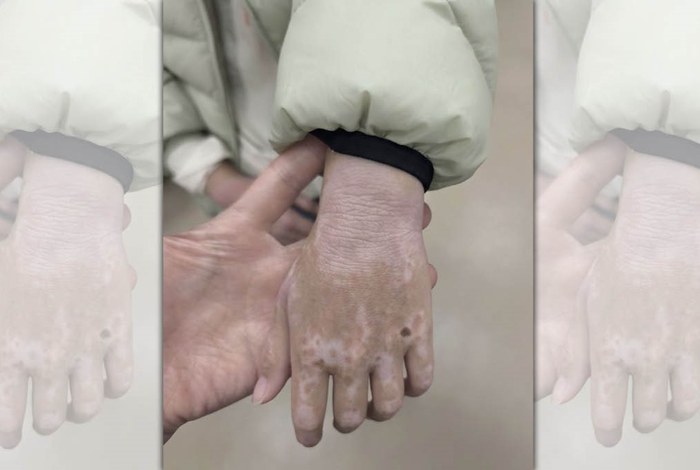 台大醫院皮膚科醫師烏惟新分享診間案例，呼籲家長切勿因恐懼類固醇而讓孩子錯過異位性皮膚炎的黃金治療期。（翻攝自臉書/皮膚專科 烏惟新醫師）
