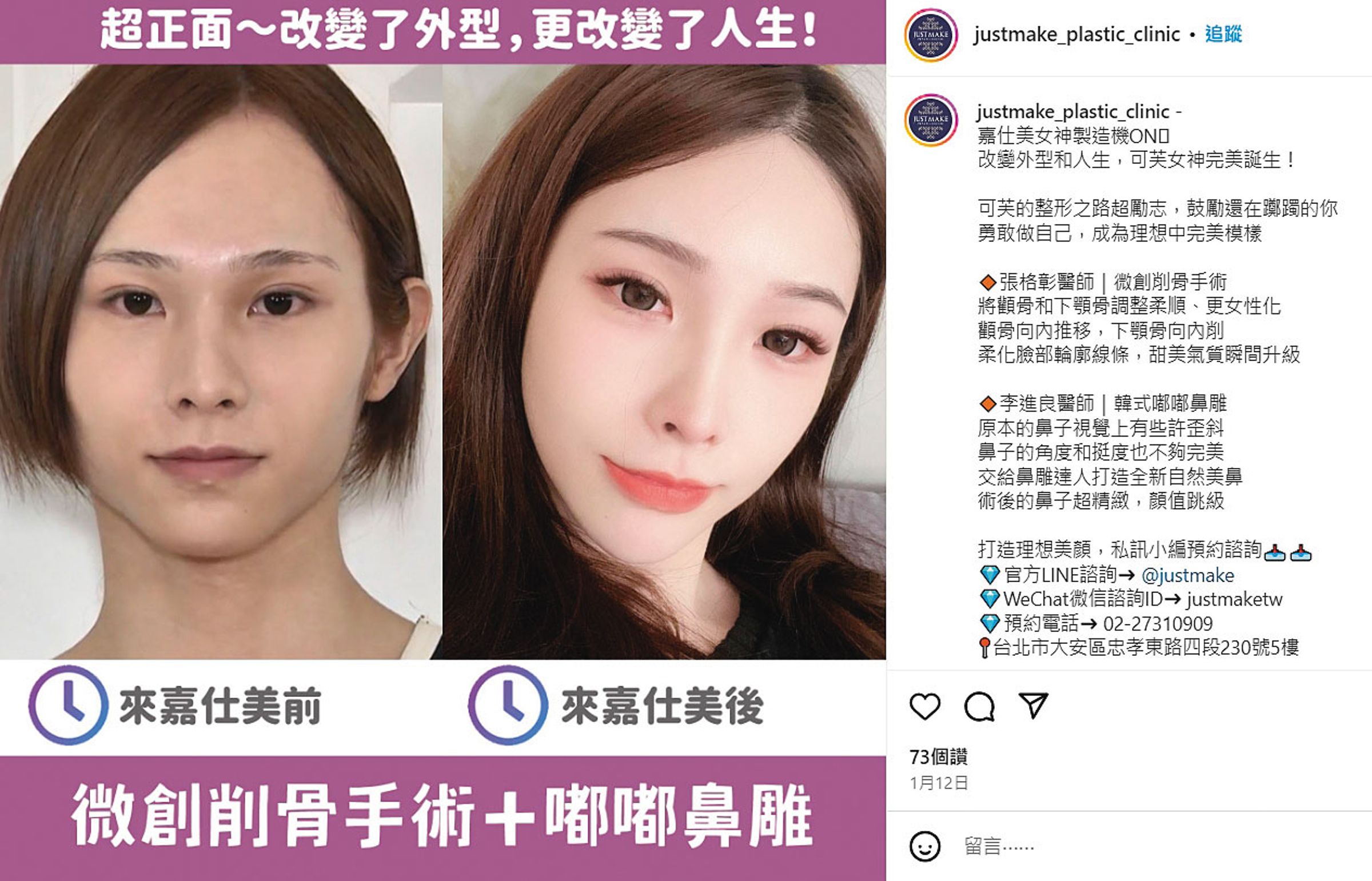 張可芙在嘉仕美診所進行過削骨、鼻雕等手術,常成為嘉仕美的宣傳案例。(翻攝嘉仕美IG)