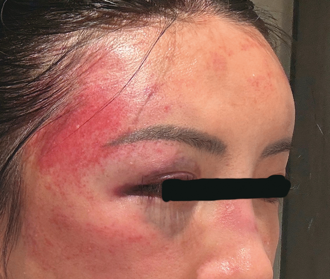 受害人遭許可宗用拳頭猛揍臉部，幾乎要面目全非。（A女提供）