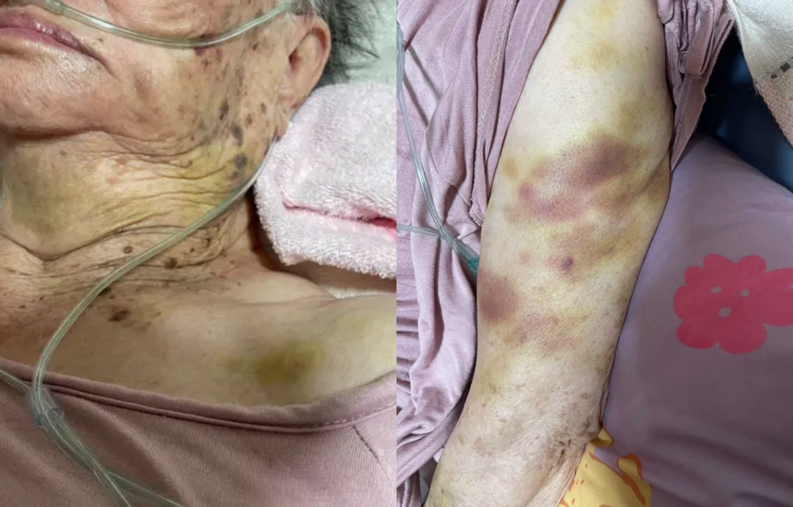 苗栗縣苑裡鎮一名高齡長者疑似遭到看護施虐，全身多處瘀青。（翻攝自Dcard）