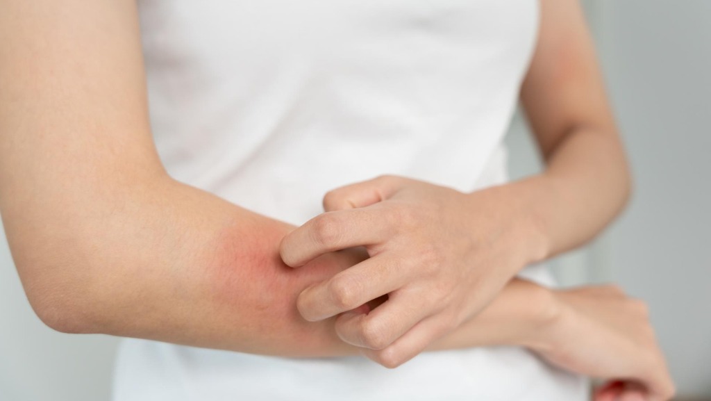 國內麻疹疫情延。示意圖。（翻攝自freepik）