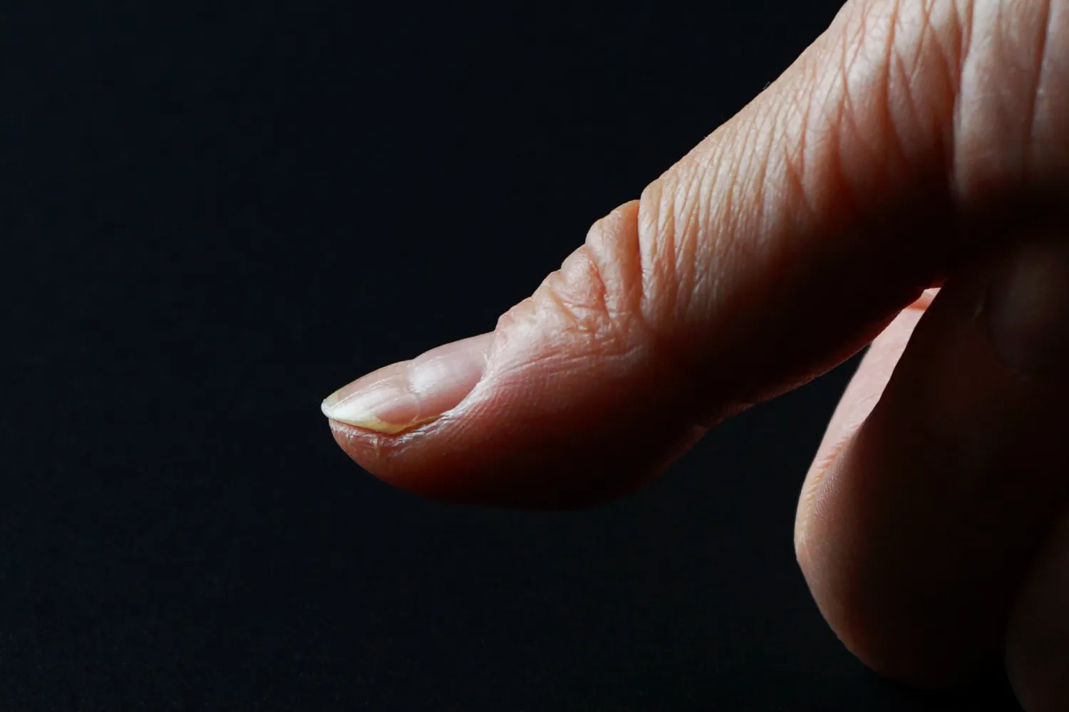 40歲女指甲「半白半紅」！原以為缺鈣　一檢查竟末期腎衰竭