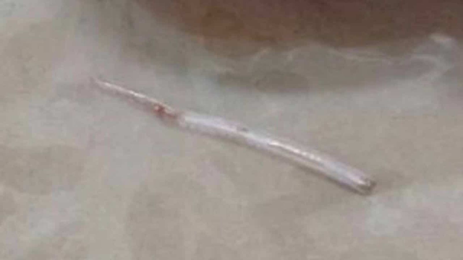 長達近2公分的魚刺卡喉2週,最終從頸部皮膚冒出,被醫師手術取出。(翻攝自thethaiger)