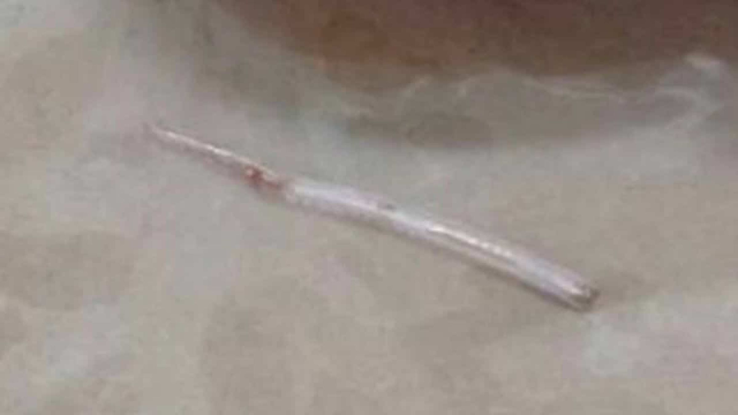 長達近2公分的魚刺卡喉2週,最終從頸部皮膚冒出,被醫師手術取出。(翻攝自thethaiger)