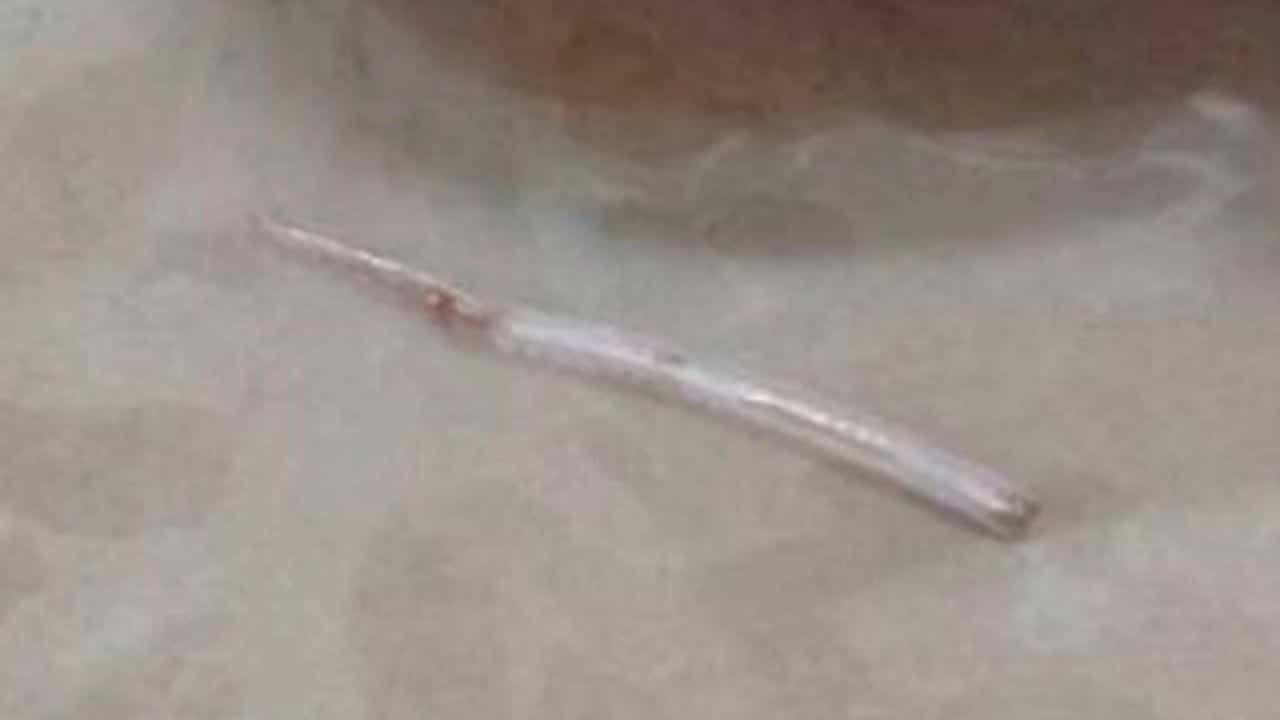 長達近2公分的魚刺卡喉2週,最終從頸部皮膚冒出,被醫師手術取出。(翻攝自thethaiger)