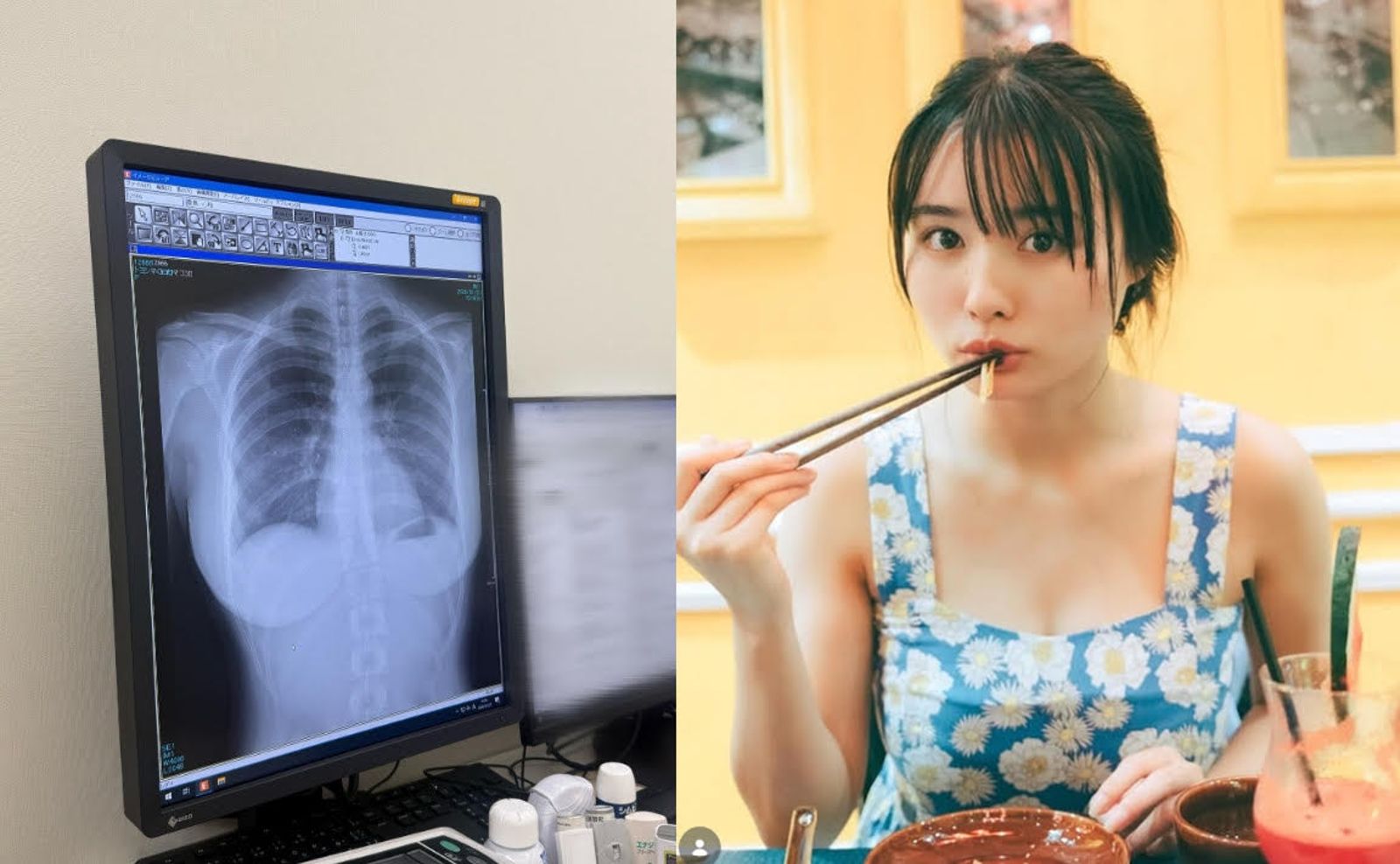 豐島心櫻在社群平台曬出胸部X光片，沒想到粉絲目光聚焦在完美胸型。（翻攝X@CocoroToyoshima、翻攝IG@cocorotoyoshima）