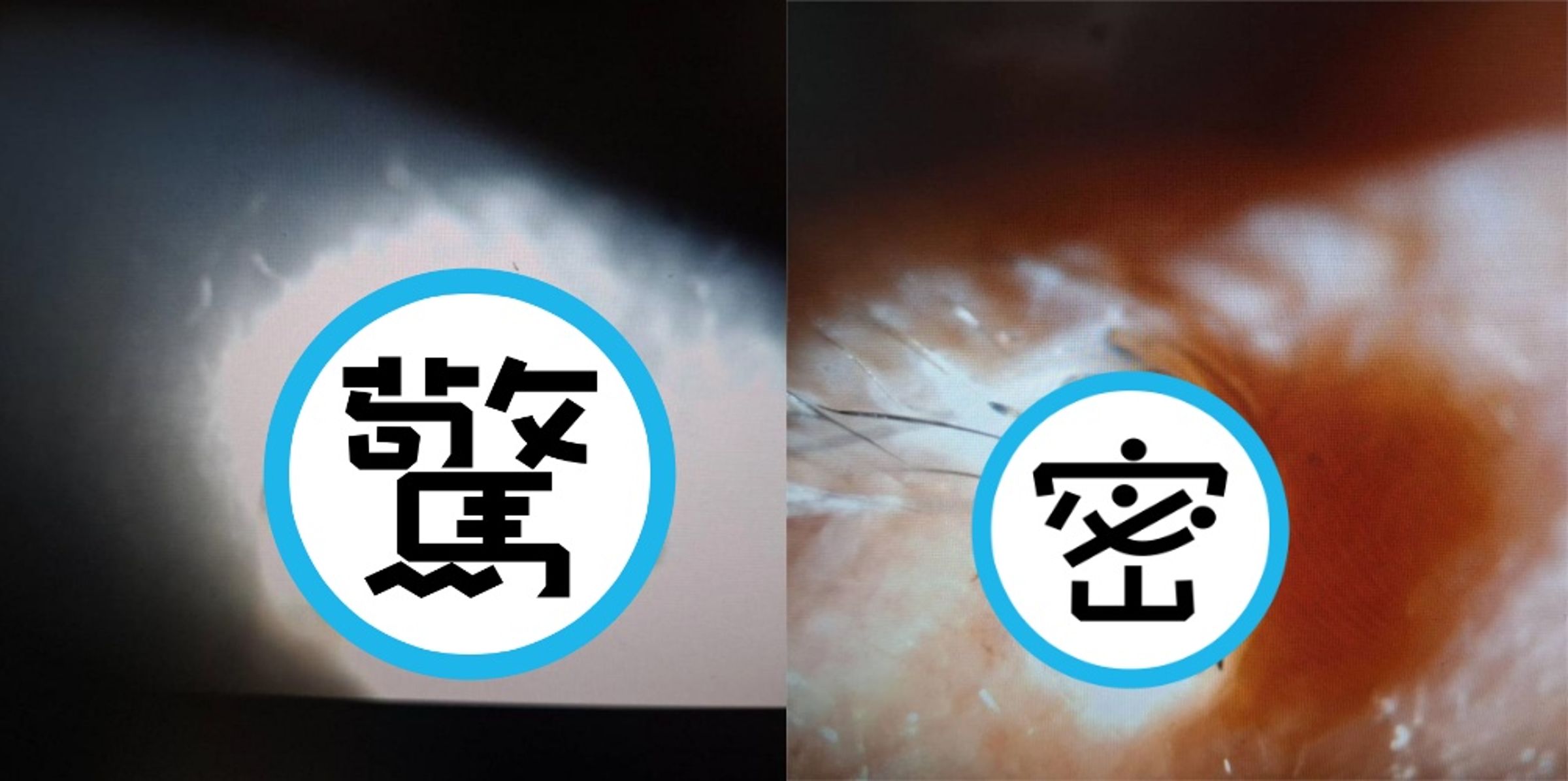 屏東中年男子右眼紅腫睜不開，竟是遭蜘蛛侵入。（洪啟庭醫師提供）