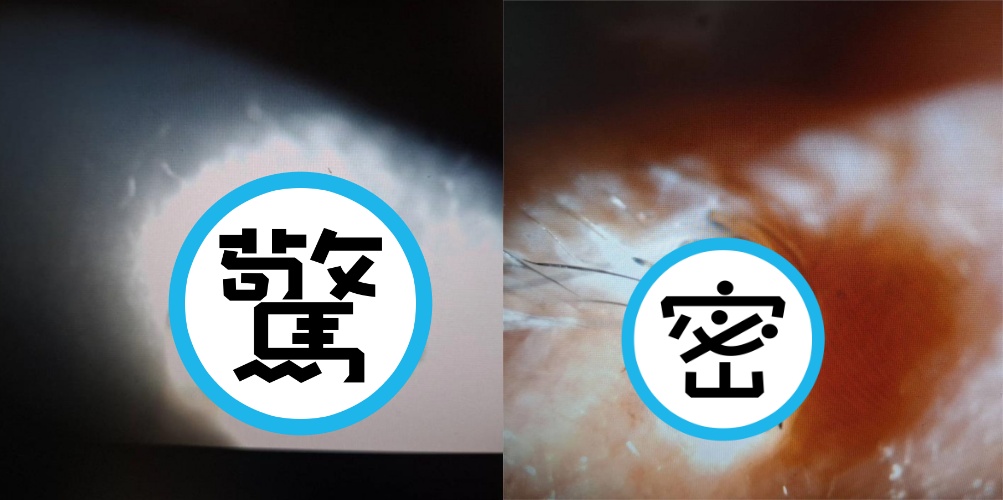 屏東中年男子右眼紅腫睜不開，竟是遭蜘蛛侵入。（洪啟庭醫師提供）