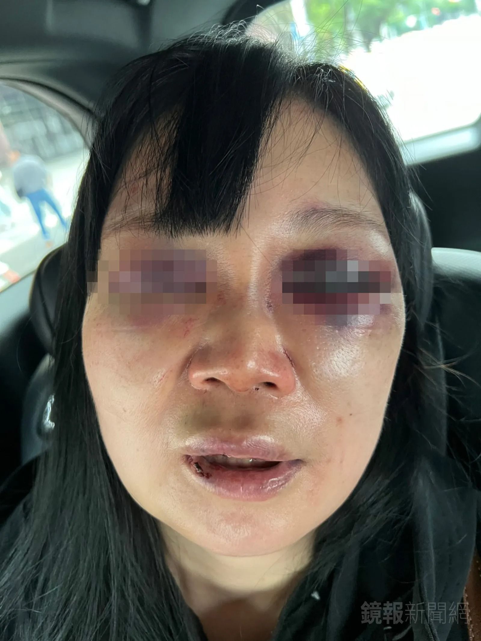 女牙醫被打到雙眼嚴重瘀青、臉部紅腫變形。（鏡報新聞網）